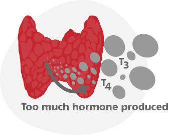hyperthyroidism
