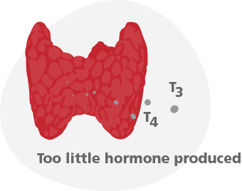 hypothyroidism